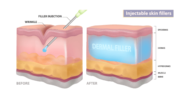 Filler Injection 1