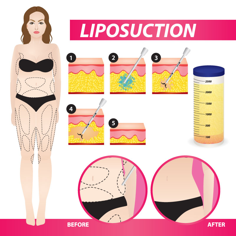 Liposuction