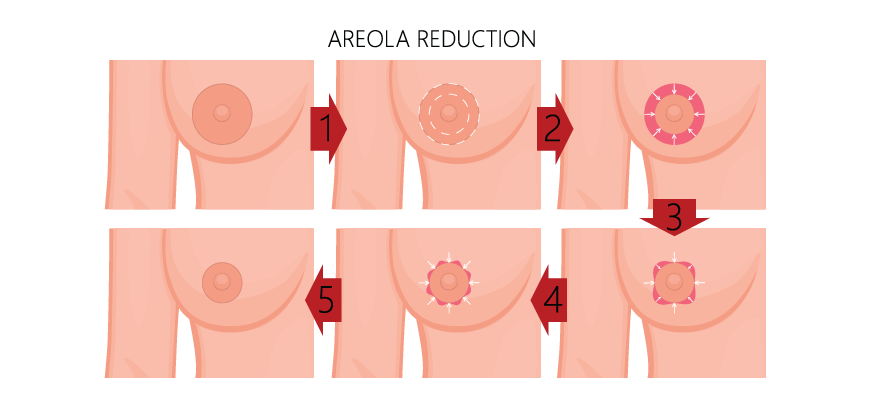 Plastic Surgery -_ Breast -_ Areola Reduction
