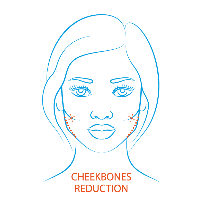 Plastic Surgery -_ Face -_ Cheekbone Reduction