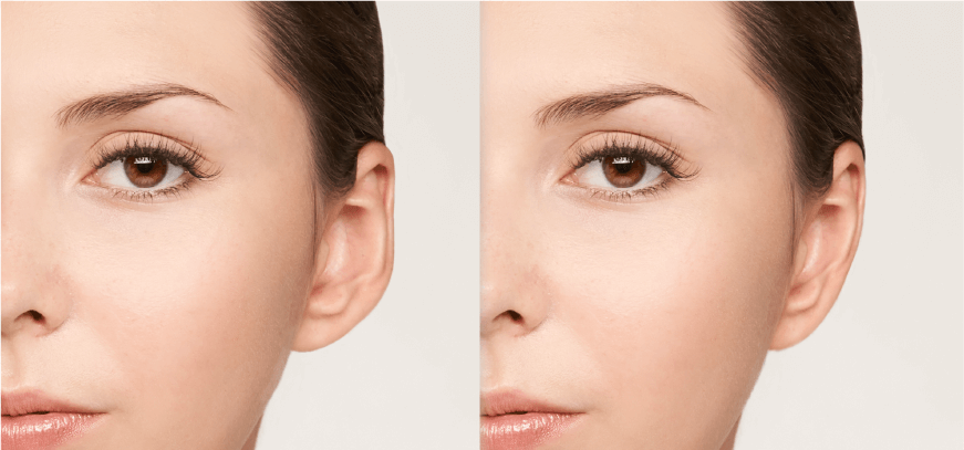 Plastic Surgery -_ Face -_ Ear Pinning