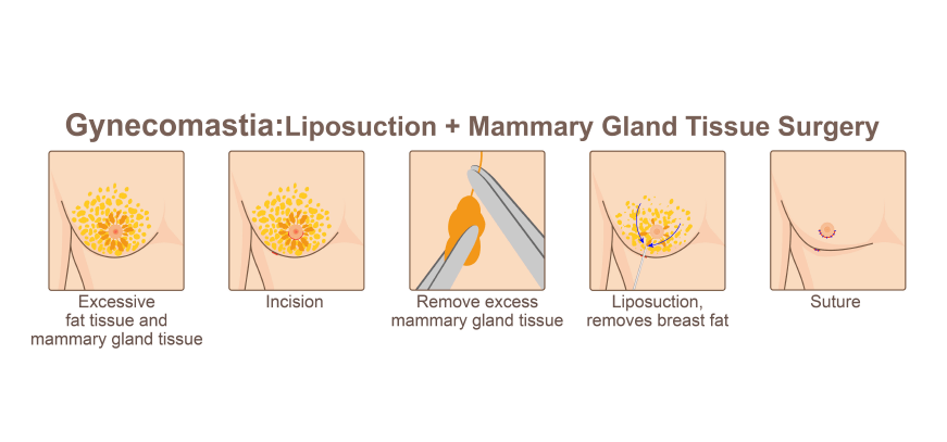 Plastic Surgery -_ Men Procedures -_ Gynecomastia 2