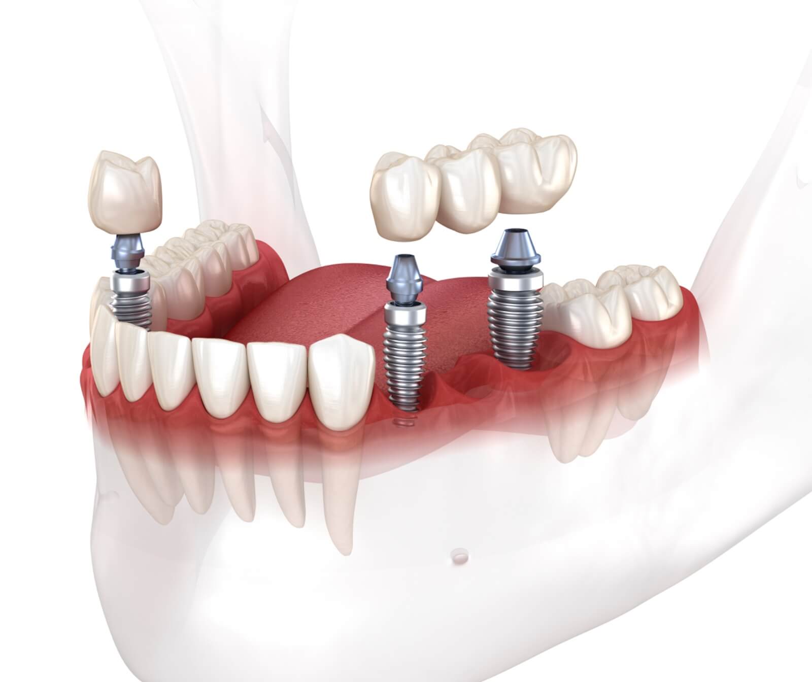Dental-implant