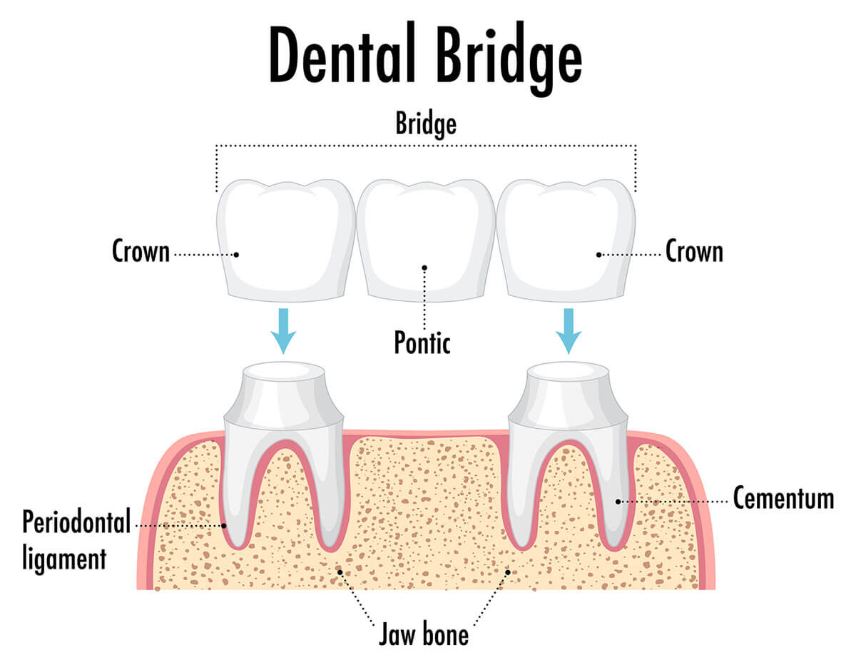 dental-bridge