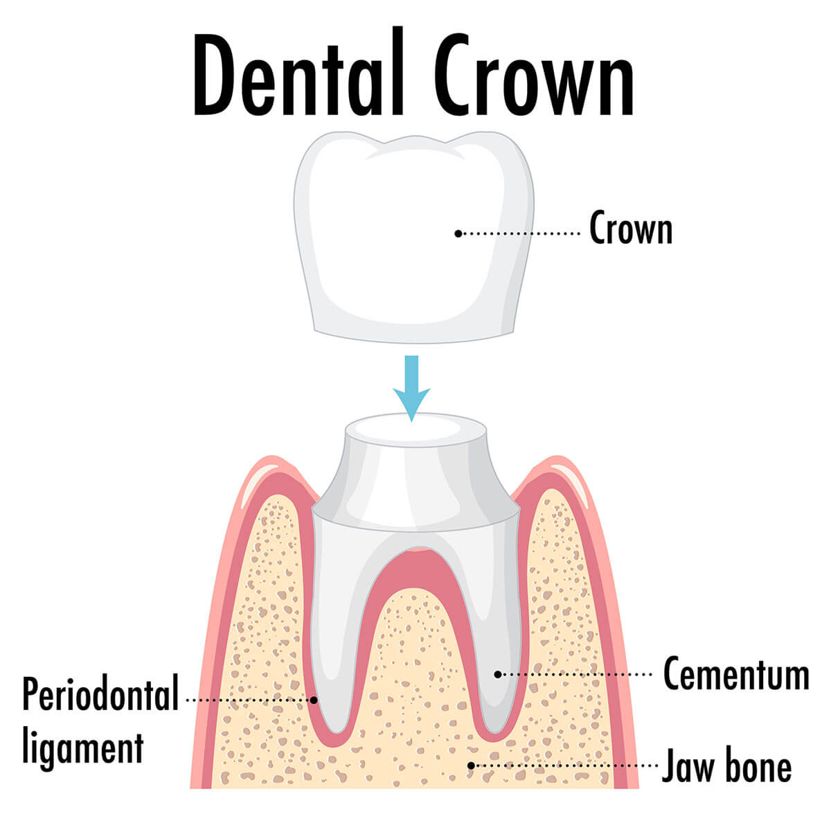 dental-crown