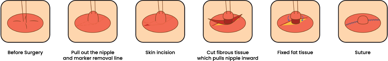nipple-correction